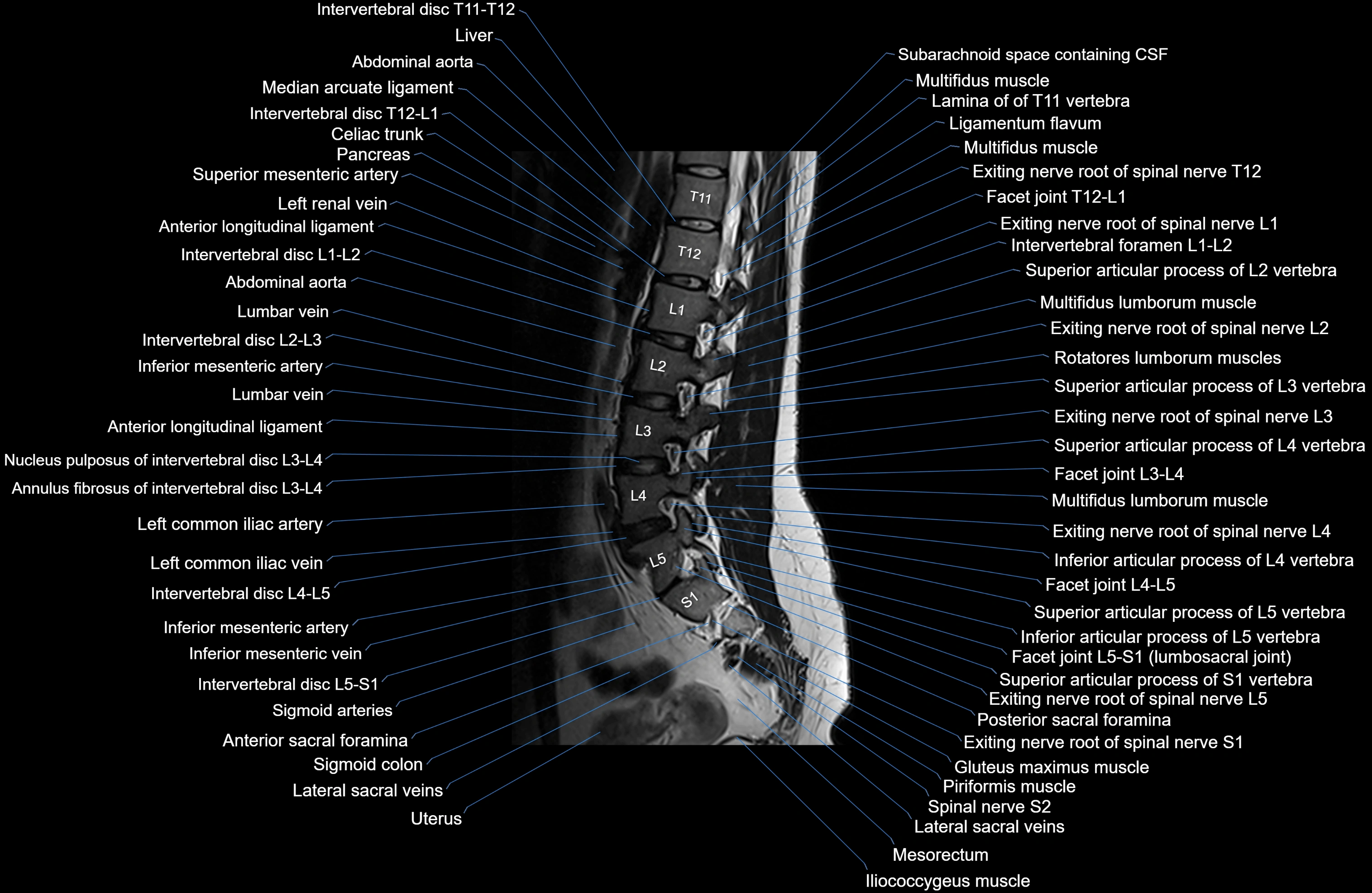 MRI lumbar spine sagittal cross sectional anatomy 3T radiology  image-img-00001-00019.webp